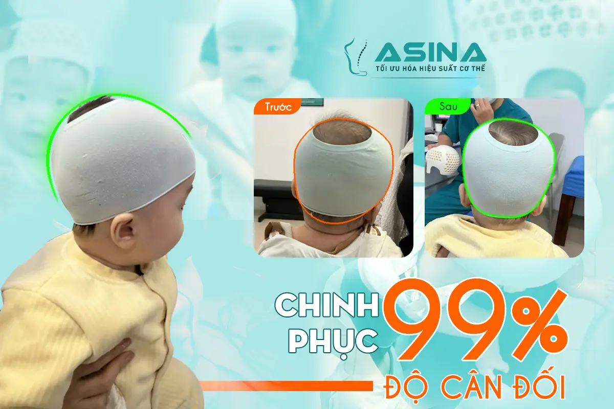Chinh phục 99% độ cân đối: Hành trình 3,5 tháng đưa đầu méo trở về “chuẩn vàng” Á Đông của bé M.H