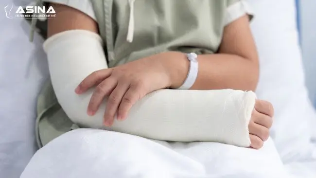 Bị rạn xương có cần bó bột không? Dấu hiệu cần cố định sớm